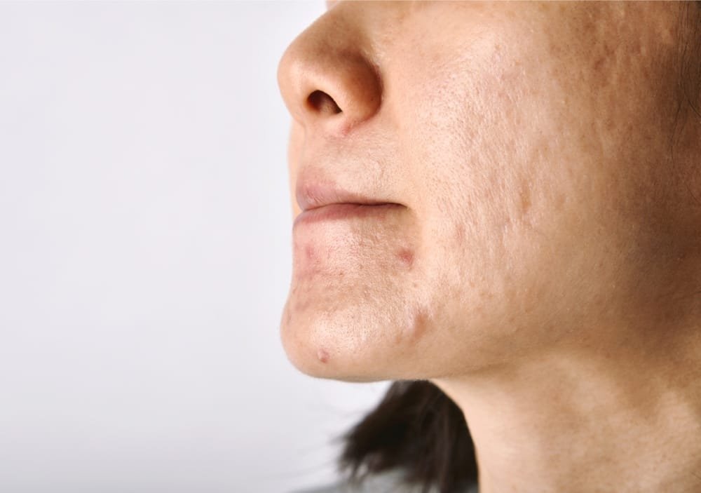 Acne Scars treatment