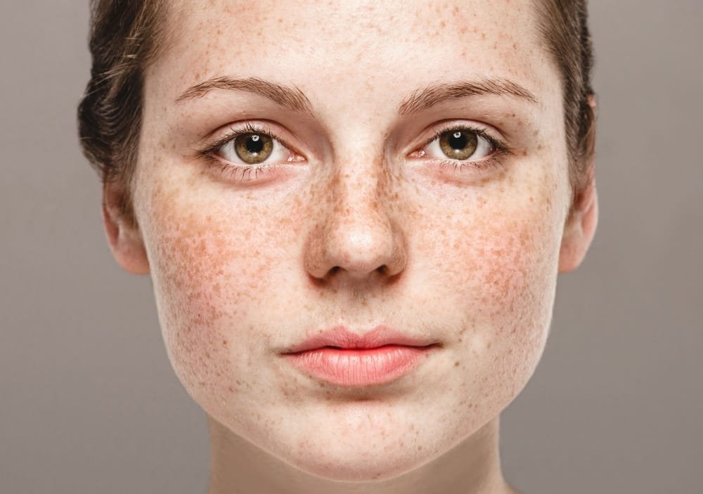 Pigmentation