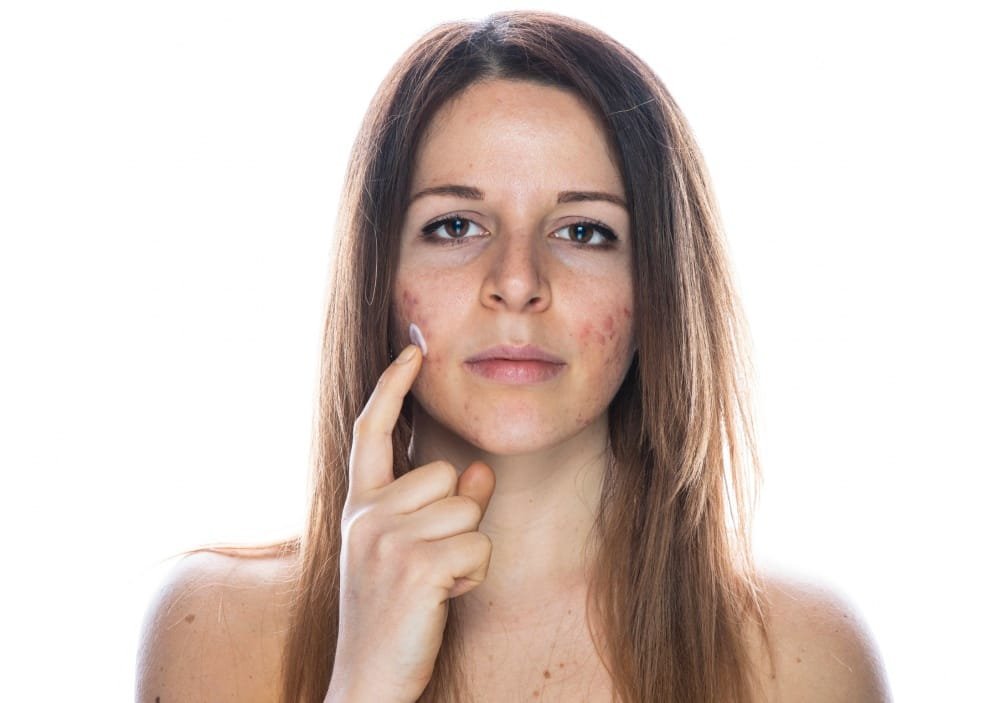 Types of acne scars