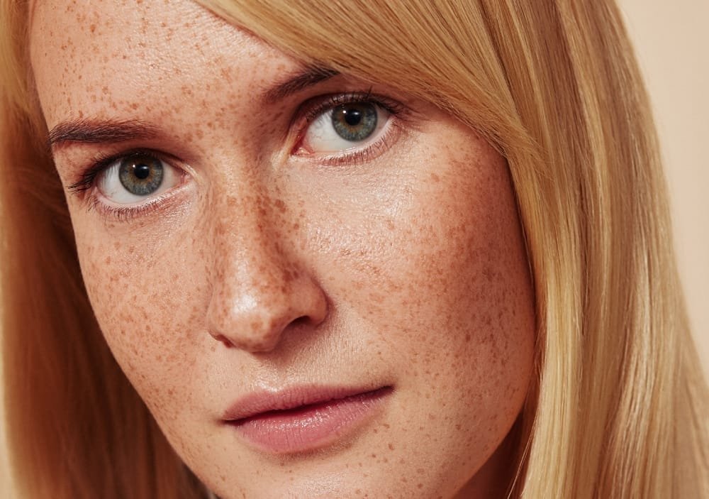 Types of Pigmentation