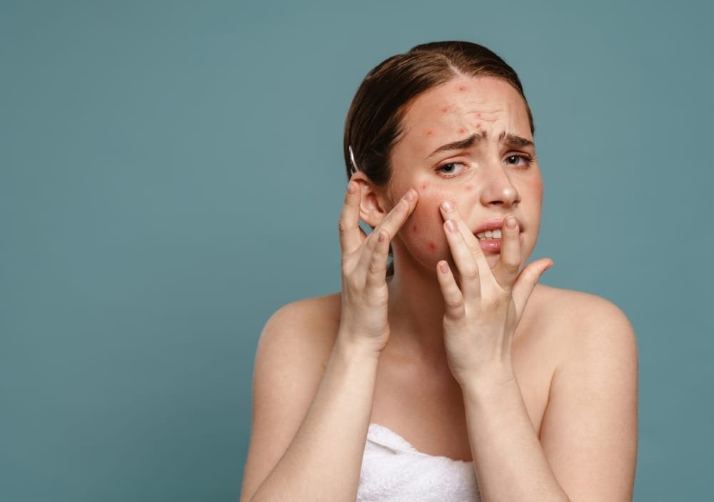 Acne on face