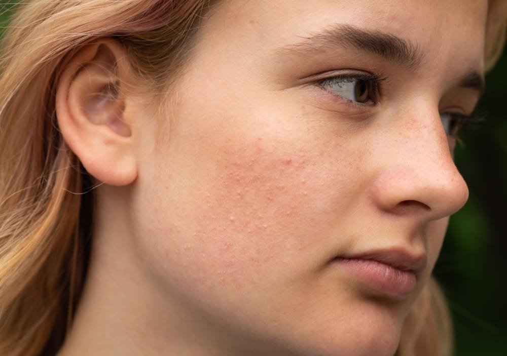 Who Can Benefit from Skin Brightening Treatments?