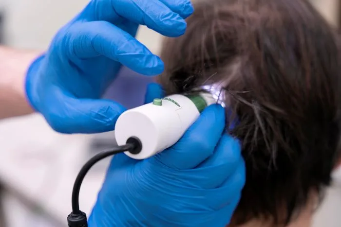 Hair restoration treatment at Klarity Skin Clinic