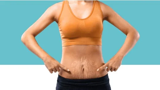 stretchmarks-banner-thumbnail