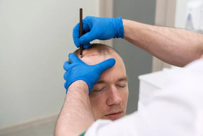 PRP treatment
