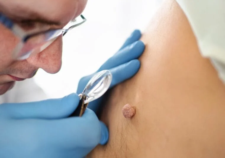 What Are Warts?