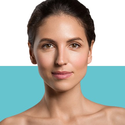 MNRF Treatment for Acne Scars