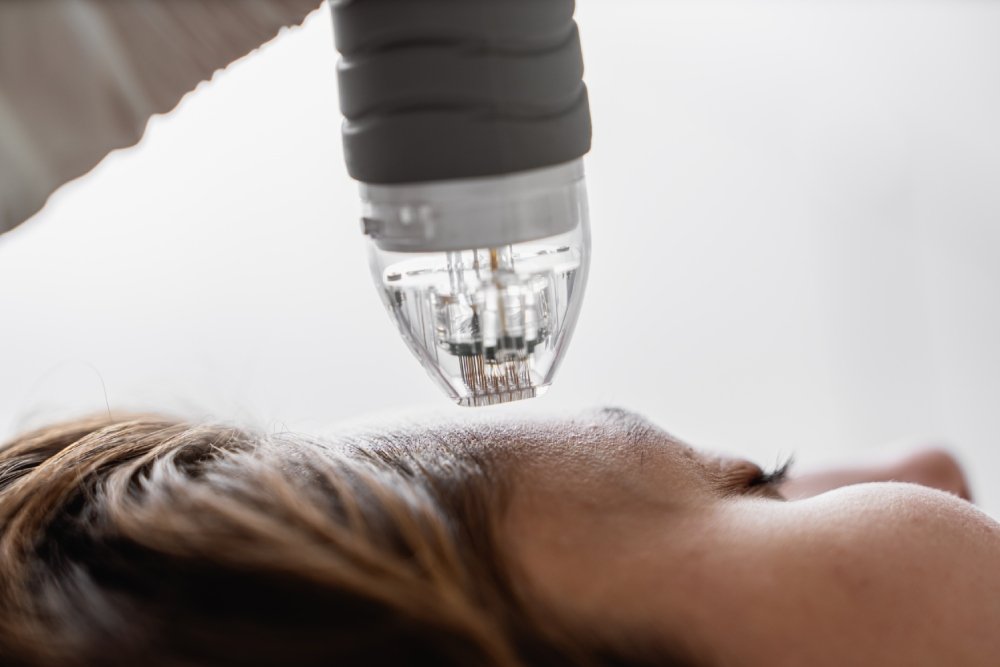 How Effective Is MNRF Treatment for Acne Scars?