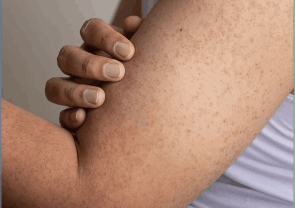 What Is Keratosis Pilaris?
