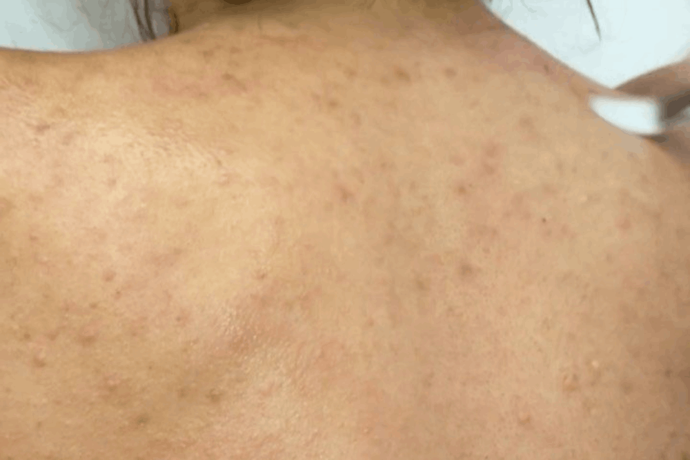 Ready for Smoother, Bump-Free Skin? Book Your Consultation Today